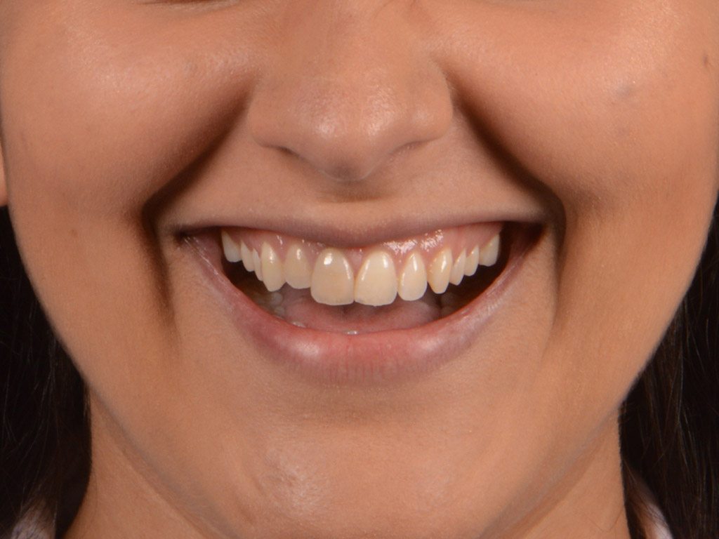 4antes