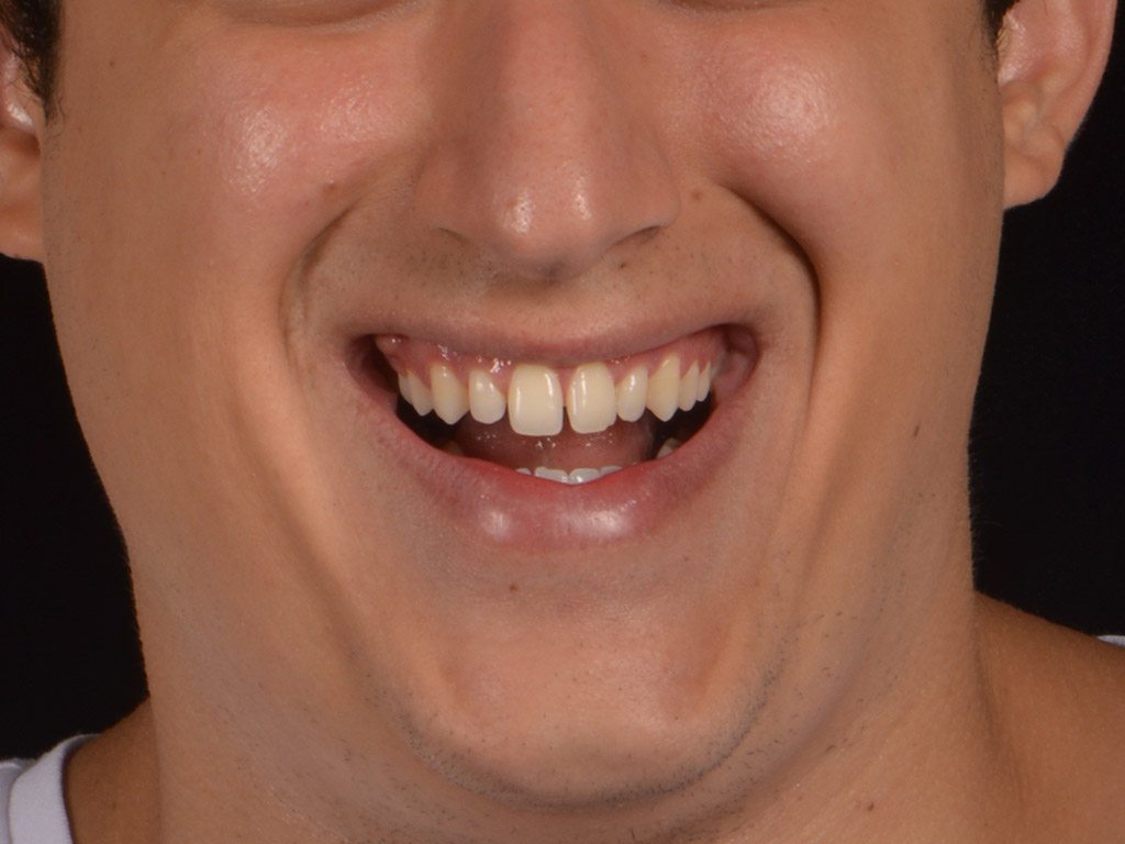 5antes
