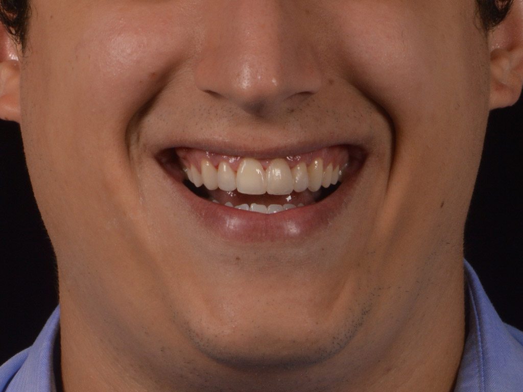 5depois